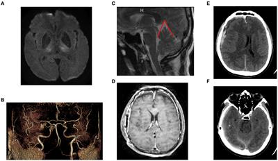 Case report: Simultaneous measurement of intracranial pressure and lumbar intrathecal pressure during epidural patch therapy for treating spontaneous intracranial hypotension syndrome. Spontaneous intracranial hypotension or spontaneous intraspinal hypovolume?